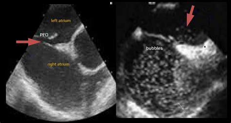 bubble diagnosis test
