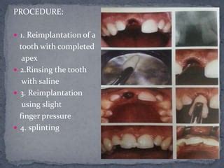 tooth reimplantation timing