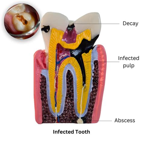untreated dental infection risk